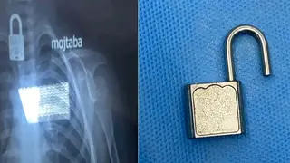 Necef'teki hastanede 4 yaşındaki çocuk metal Kilit yutması sonucu kurtarıldı