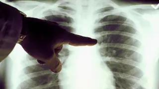 Pankreas Kanseri İçin Beklenmedik Bir Risk Faktörü: Vücuttaki Mineral Düzeyleri