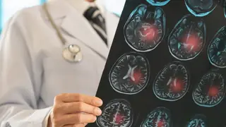 Yeni bir ilaç inme korumasının geleceğini değiştirebilir